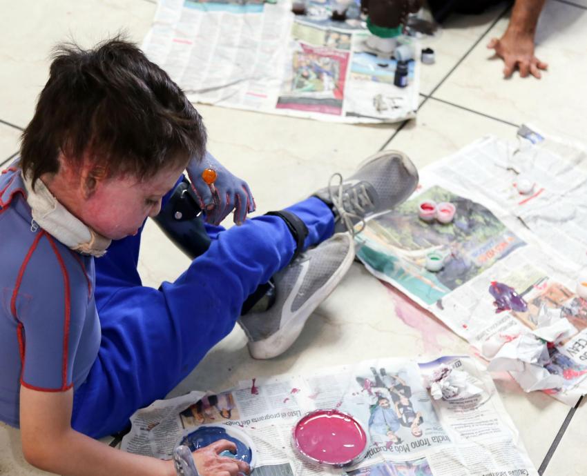 En 20 años beneficiados 4 mil niños con secuelas de quemaduras