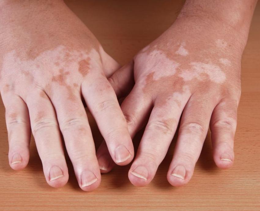 Celebran Día Mundial del Vitiligo: lo padece 2  por ciento  de la población mundial