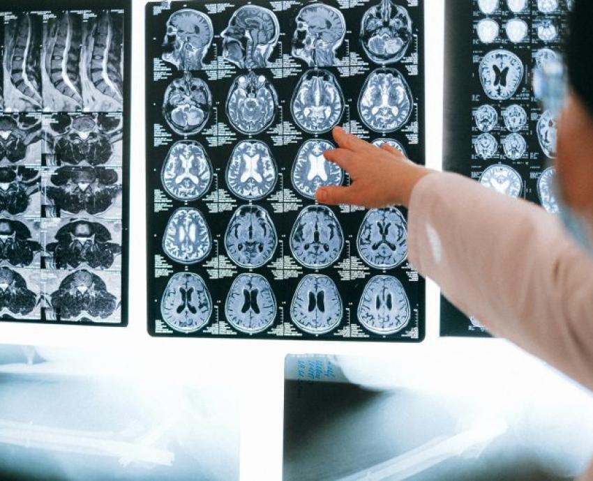 Alimentos hipercalóricos inciden en el desarrollo de enfermedades del cerebro